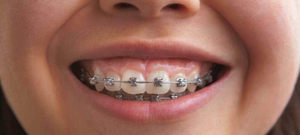 Close up of the mouth of a girl with dental braces.
